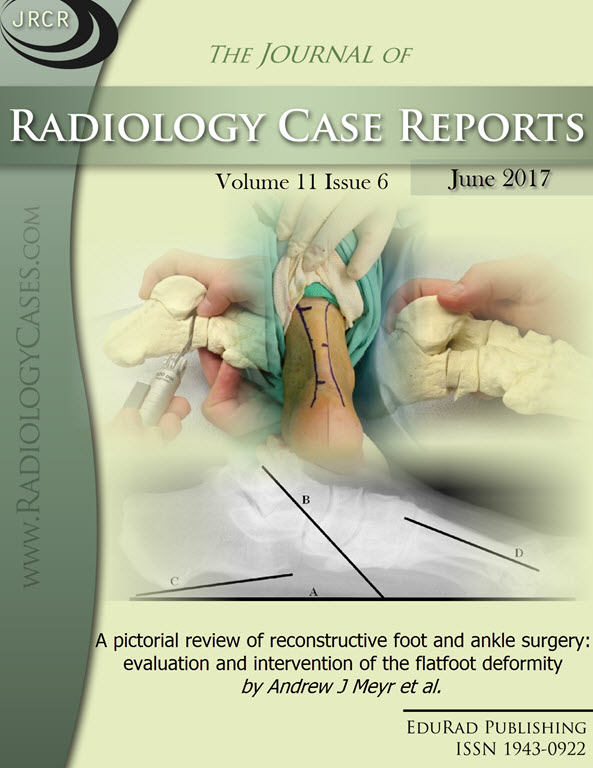 Journal of Radiology Case Reports June 2017 issue - Cover page: A pictorial review of reconstructive foot and ankle surgery: evaluation and intervention of the flatfoot deformity by Andrew J Meyr et al.