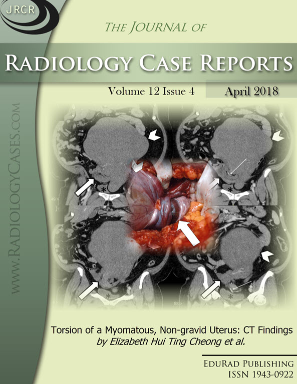 Journal of Radiology Case Reports April 2018 issue - Cover page: Torsion of a Myomatous, Non-gravid Uterus: CT Findings by Elizabeth Hui Ting Cheong et al.