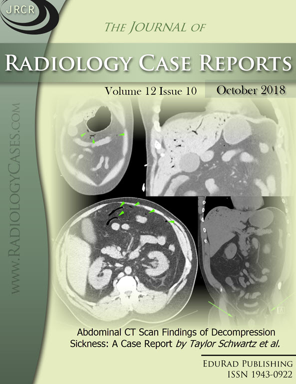Abdominal CT Scan Findings of Decompression Sickness: A Case Report by Taylor Schwartz et al.