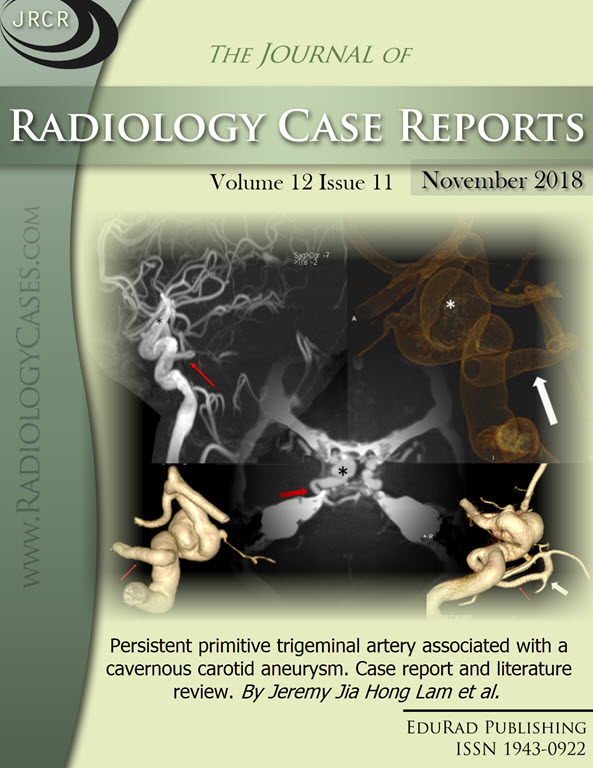 Persistent primitive trigeminal artery associated with a cavernous carotid aneurysm. Case report and literature review. By Jeremy Jia Hong Lam et al.