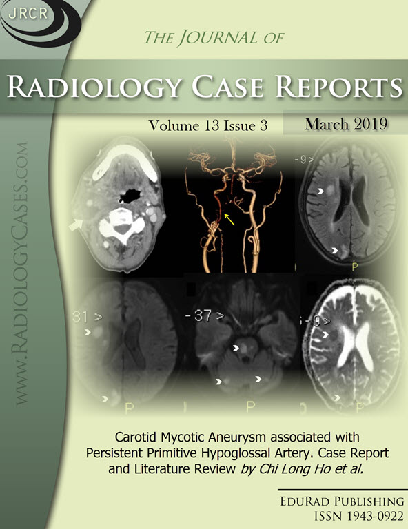 Journal of Radiology Case Reports March 2019 issue - Cover page: Carotid Mycotic Aneurysm associated with Persistent Primitive Hypoglossal Artery. Case Report and Literature Review by Chi Long Ho et al.