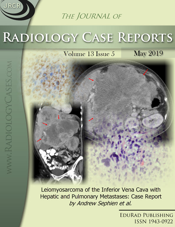 Journal of Radiology Case Reports May 2019 issue - Cover page: Leiomyosarcoma of the Inferior Vena Cava with Hepatic and Pulmonary Metastases: Case Report by Andrew Sephien et al.