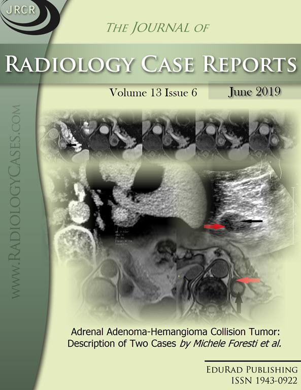 Adrenal Adenoma-Hemangioma Collision Tumor: Description of Two Cases by Michele Foresti et al.