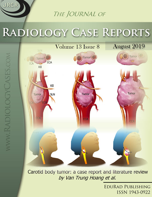 Carotid body tumor: a case report and literature review by Van Trung Hoang et al.