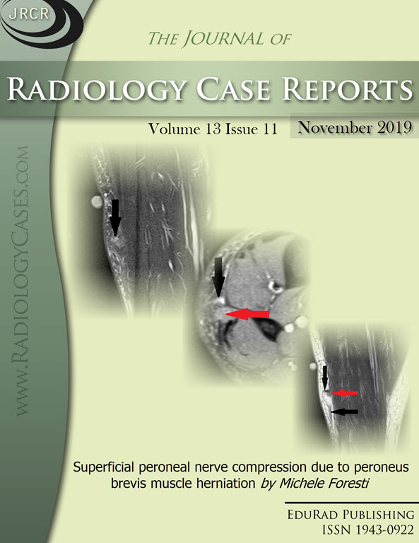 Journal of Radiology Case Reports November 2019 issue - Cover page: Superficial peroneal nerve compression due to peroneus brevis muscle herniation by Michele Foresti