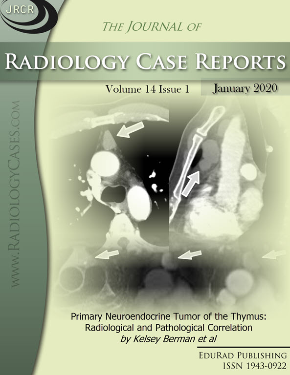 Journal of Radiology Case Reports January 2020 issue - Cover page: Primary Neuroendocrine Tumor of the Thymus: Radiological and Pathological Correlation by Kelsey Berman et al