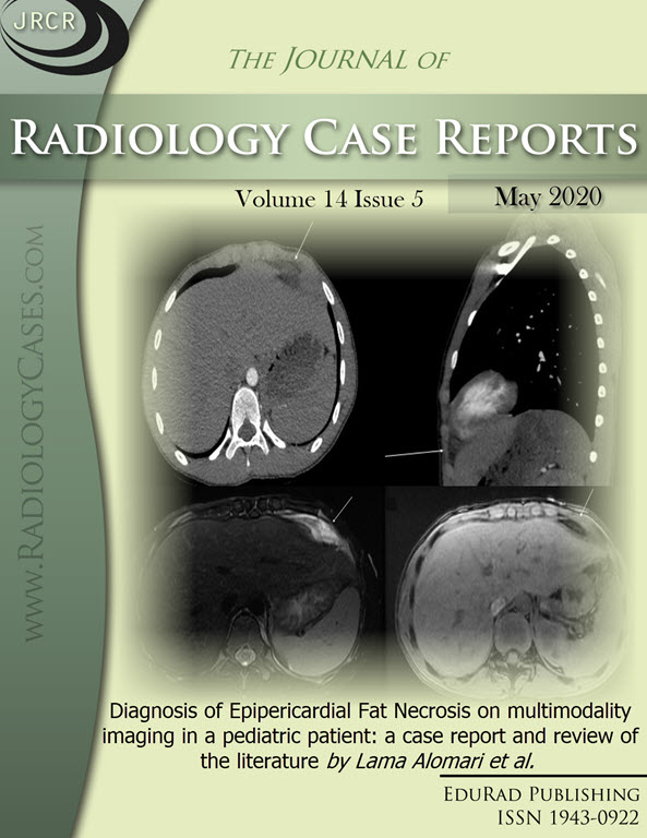 Journal of Radiology Case Reports May 2020 issue - Cover page: Diagnosis of Epipericardial Fat Necrosis on multimodality imaging in a pediatric patient: a case report and review of the literature by Lama Alomari et al.