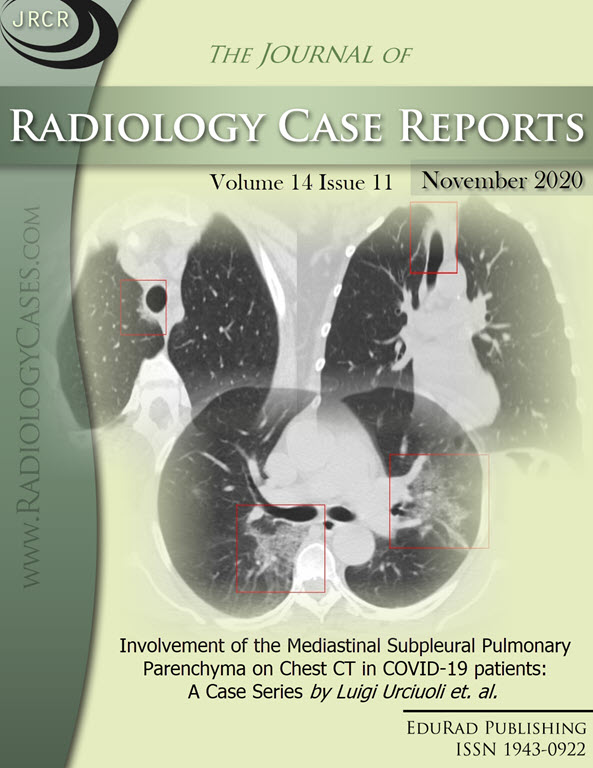 Involvement of the Mediastinal Subpleural Pulmonary Parenchyma on Chest CT in COVID-19 patients: A Case Series by Luigi Urciuoli et. al.