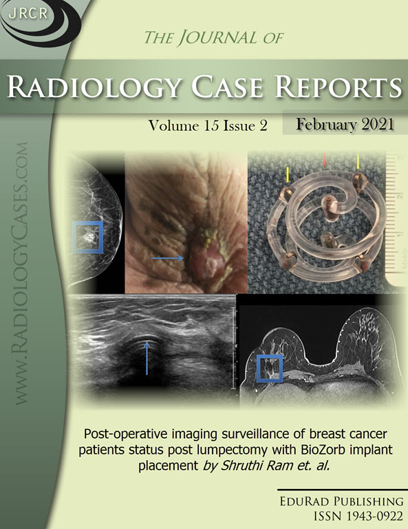 Post-operative imaging surveillance of breast cancer patients status post lumpectomy with BioZorb implant placement by Shruthi Ram et. al.