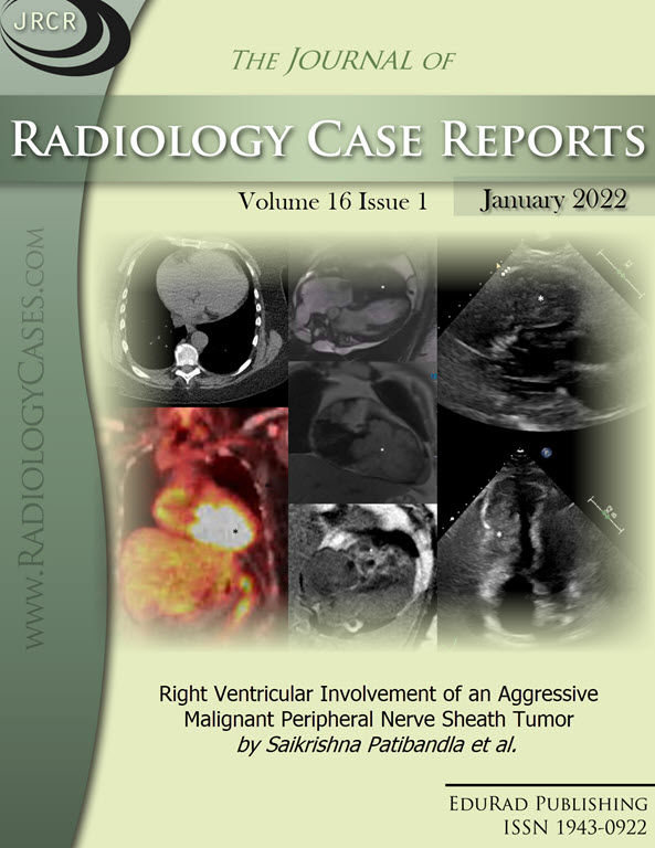 Right Ventricular Involvement of an Aggressive Malignant Peripheral Nerve Sheath Tumor by Saikrishna Patibandla et al.