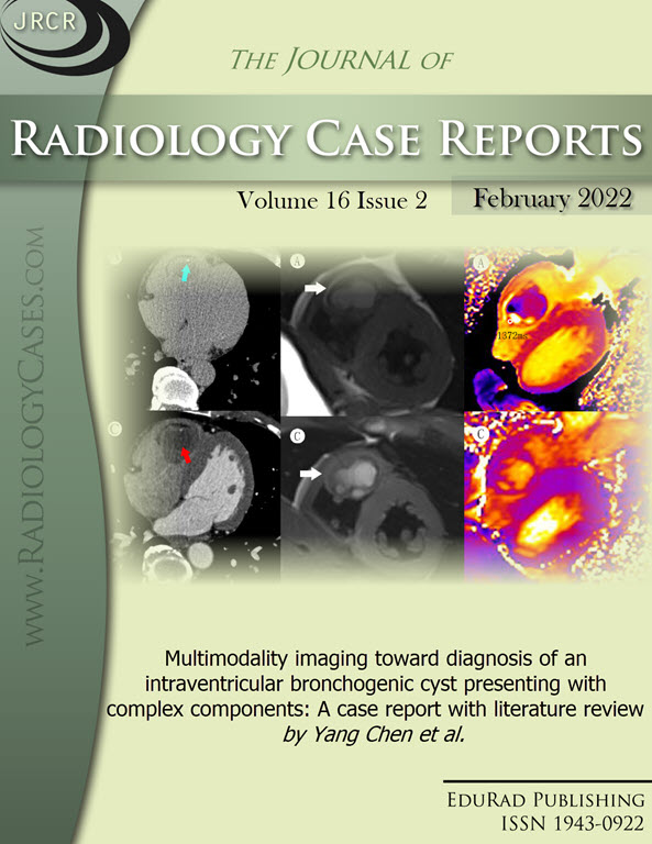 Multimodality imaging toward diagnosis of an intraventricular bronchogenic cyst presenting with complex components: A case report with literature review by Yang Chen et al.