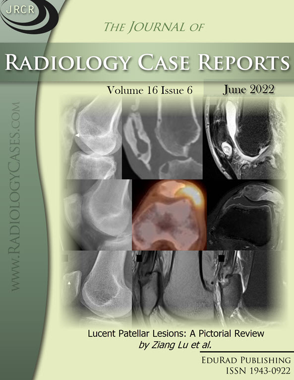 Journal of Radiology Case Reports June 2022 issue - Cover page: Lucent Patellar Lesions: A Pictorial Review by Ziang Lu et al.