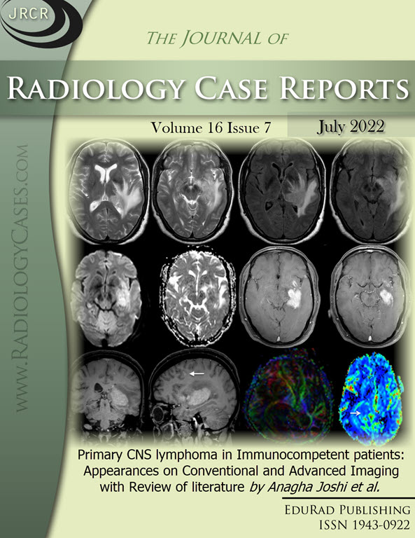 Primary CNS lymphoma in Immunocompetent patients: Appearances on Conventional and Advanced Imaging with Review of literature by Anagha Joshi et al.