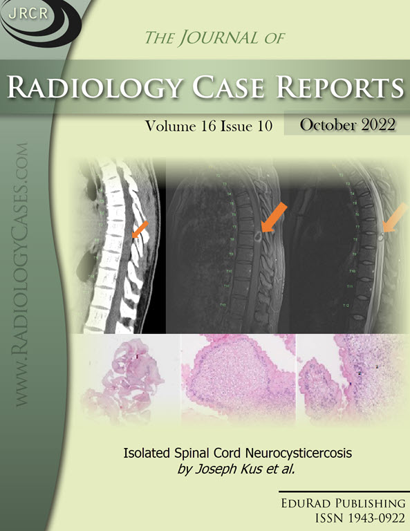Journal of Radiology Case Reports October 2022 issue - Cover page: Isolated Spinal Cord Neurocysticercosis by Joseph Kus et al.