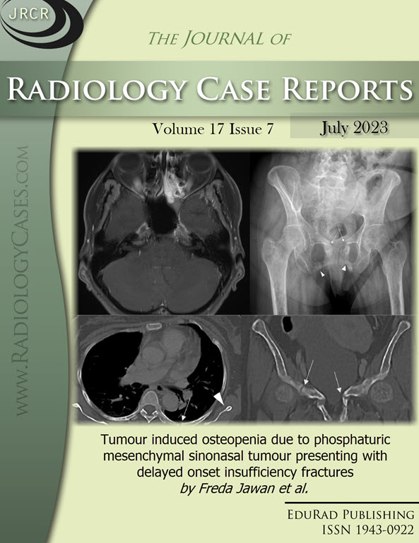 Journal of Radiology Case Reports July 2023 issue cover page: Tumour induced osteopenia due to phosphaturic mesenchymal sinonasal tumour presenting with delayed onset insufficiency fractures by Freda Jawan et al.