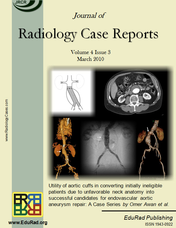 Journal of Radiology Case Reports March 2010 issue cover page: "Utility of aortic cuffs in converting initially ineligible patients due to unfavorable neck anatomy into successful candidates for endovascular aortic aneurysm repair" by Omer Awan et. Al.