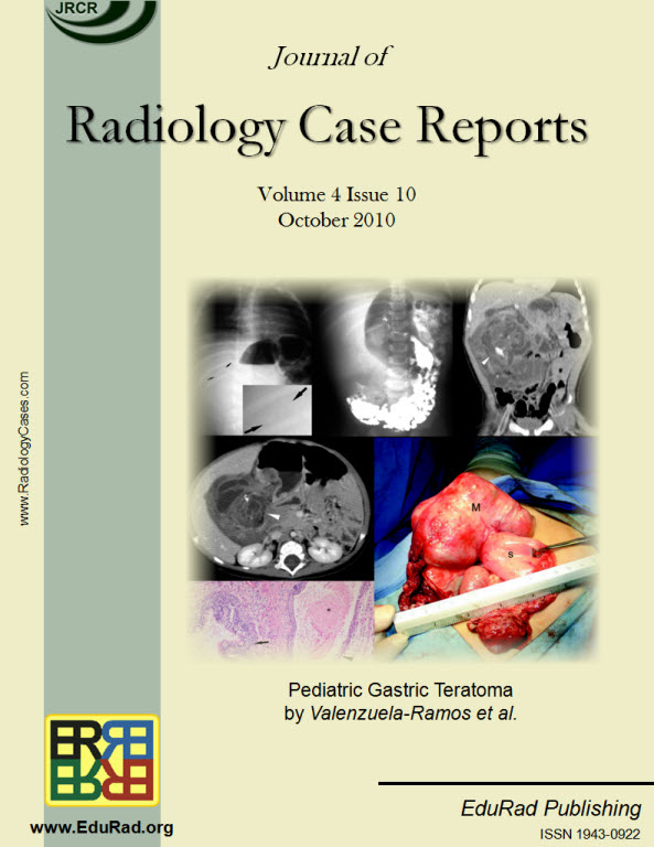 Journal of Radiology Case Reports October 2010 issue. Pediatric Gastric Teratoma by Valenzuela-Ramos et al.