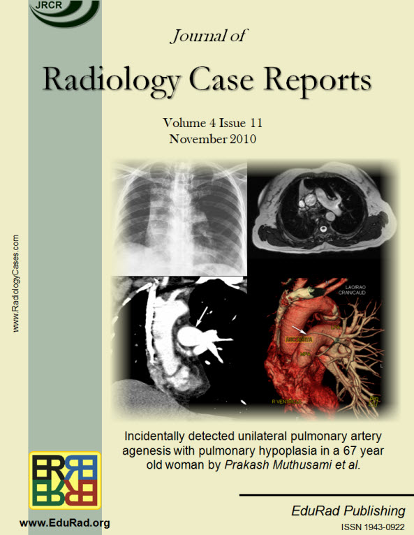 Journal of Radiology Case Reports November 2010 issue. Incidentally detected unilateral pulmonary artery agenesis with pulmonary hypoplasia in a 67 year old woman by Prakash Muthusami et al.