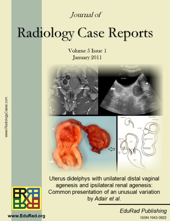 Journal of Radiology Case Reports January 2011 issue - Uterus didelphys with unilateral distal vaginal agenesis and ipsilateral renal agenesis:  Common presentation of an unusual variation by Adair et al.