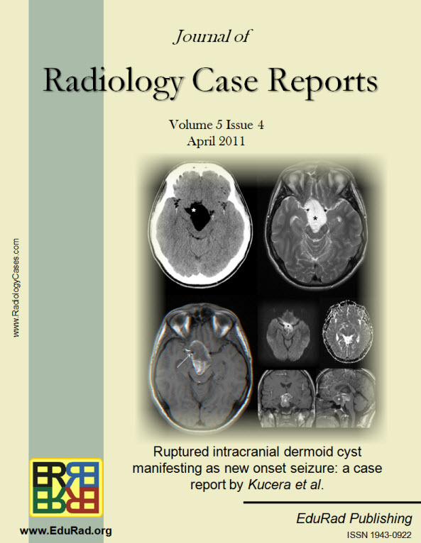 Journal of Radiology Case Reports April 2011 issue - Ruptured intracranial dermoid cyst manifesting as new onset seizure: a case report by Kucera et al.