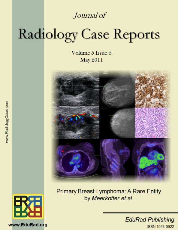 Journal of Radiology Case Reports May 2011 issue - Primary Breast Lymphoma: A Rare Entity by Meerkotter et al.