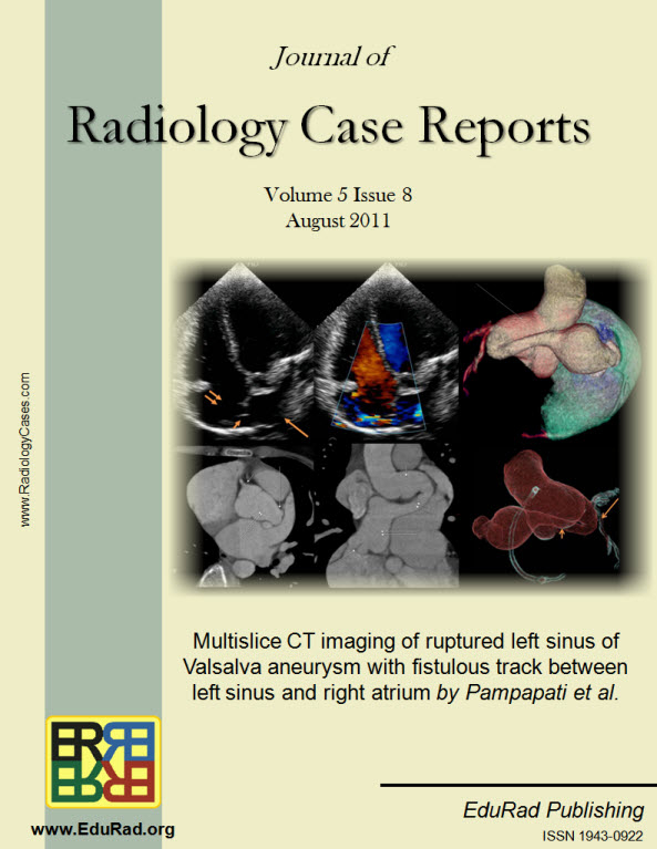 Multislice CT imaging of ruptured left sinus of Valsalva aneurysm with fistulous track between left sinus and right atrium by Pampapati et al.