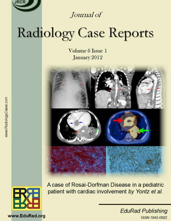 Journal of Radiology Case Reports January 2012 issue - A case of Rosai-Dorfman Disease in a pediatric patient with cardiac involvement by Yontz et al.