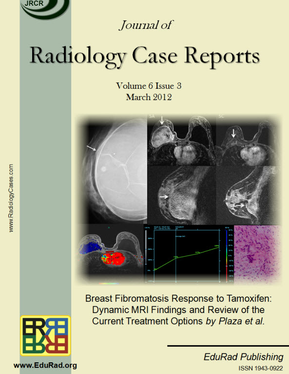 Journal of Radiology Case Reports March 2012 issue - Breast Fibromatosis Response to Tamoxifen: Dynamic MRI Findings and Review of the Current Treatment Options by Plaza et al.