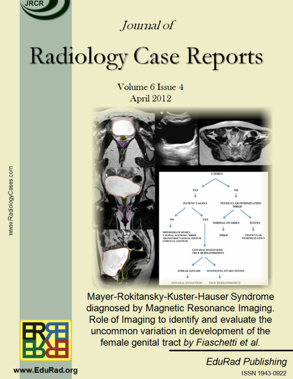 Journal of Radiology Case Reports April 2012 issue - Mayer-Rokitansky-Kuster-Hauser Syndrome diagnosed by Magnetic Resonance Imaging. Role of Imaging to identify and evaluate the uncommon variation in development of the female genital tract by Fiaschetti