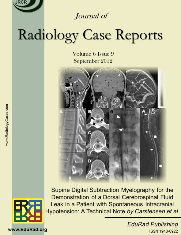 Journal of Radiology Case Reports September 2012 issue - Supine Digital Subtraction Myelography for the Demonstration of a Dorsal Cerebrospinal Fluid Leak in a Patient with Spontaneous Intracranial Hypotension: A Technical Note by Carstensen et al.