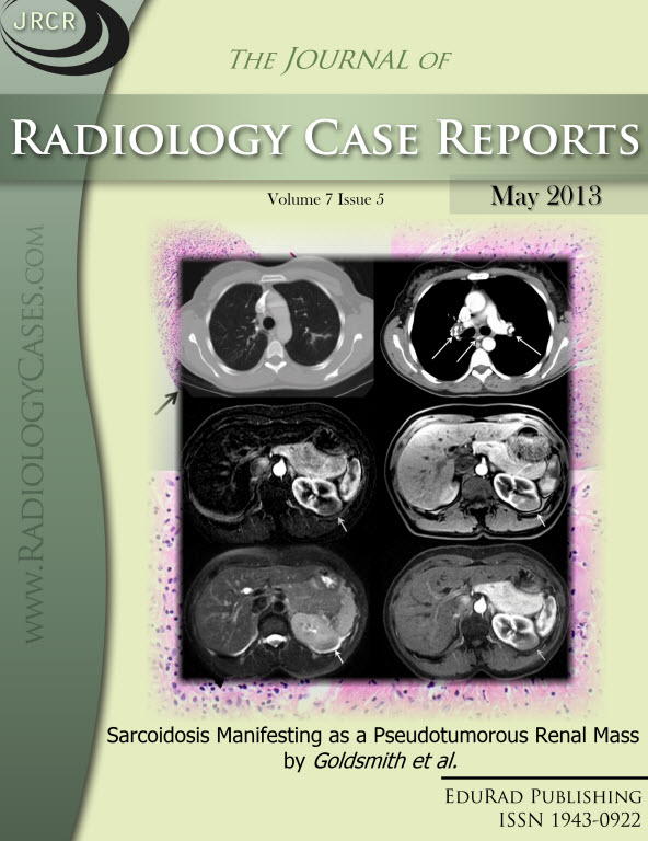 Journal of Radiology Case Reports May 2013 issue - Cover page: Sarcoidosis Manifesting as a Pseudotumorous Renal Mass by Goldsmith et al.