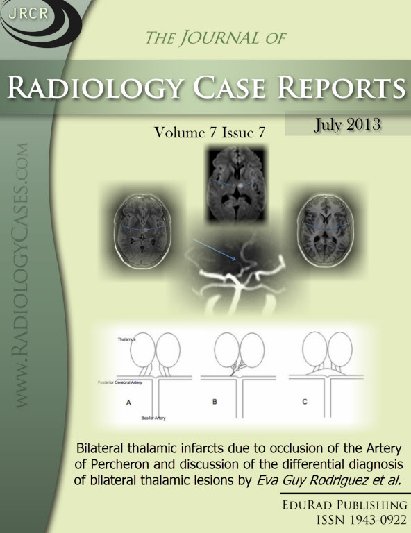 Journal of Radiology Case Reports July 2013 issue - Cover page: Bilateral thalamic infarcts due to occlusion of the Artery of Percheron and discussion of the differential diagnosis of bilateral thalamic lesions by Eva Guy Rodriguez et al.