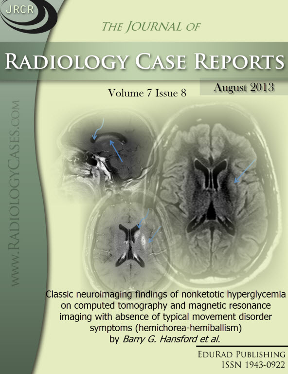 Journal of Radiology Case Reports August 2013 issue - Cover page: Classic neuroimaging findings of nonketotic hyperglycemia on computed tomography and magnetic resonance imaging with absence of typical movement disorder symptoms (hemichorea-hemiballism) b