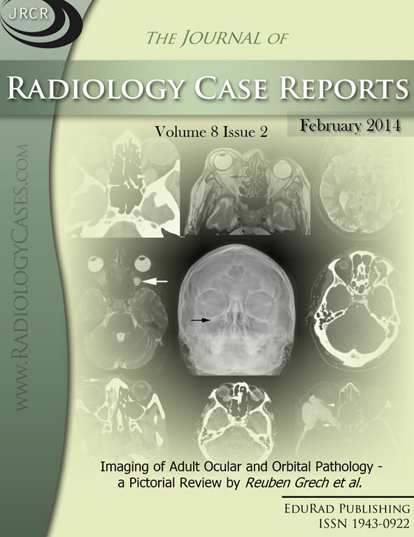 Journal of Radiology Case Reports February 2014 issue - Cover page: Imaging of Adult Ocular and Orbital Pathology - a Pictorial Review - by Reuben Grech et al.