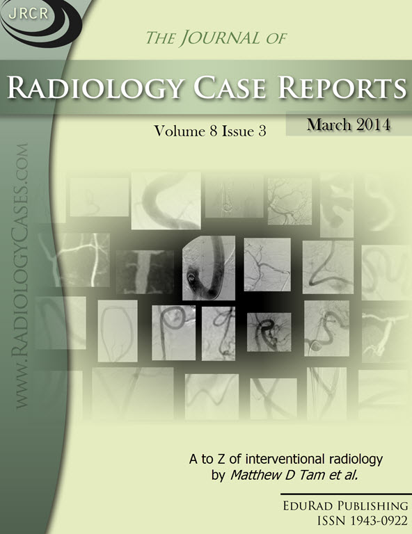 Journal of Radiology Case Reports March 2014 issue - Cover page: A to Z of interventional radiology by Matthew D Tam