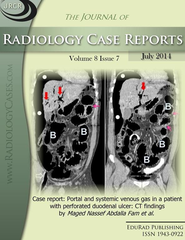 Journal of Radiology Case Reports July 2014 issue - Cover page: Case report: Portal and systemic venous gas in a patient with perforated duodenal ulcer: CT findings by Maged Nassef Abdalla Fam et al.