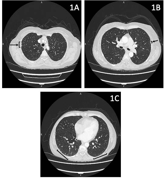 60-year-old lady with hepatopulmonary syndrome