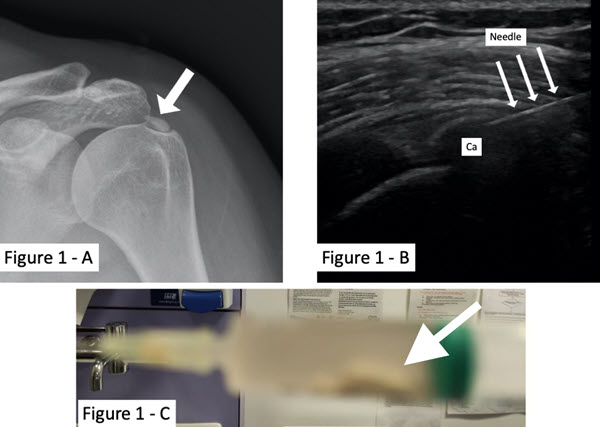 Complication of barbotage, acute calcific bursitis treated successfully
