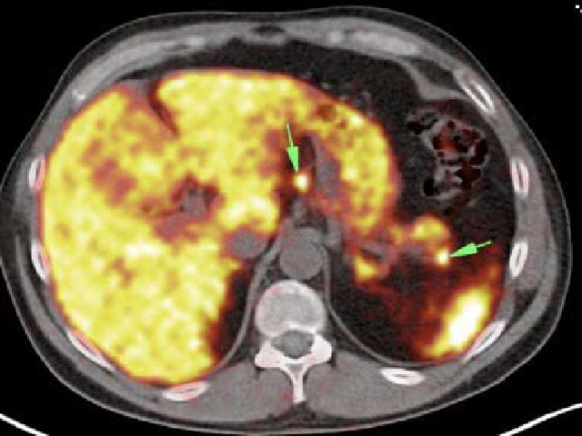 PET-CT with 68Ga shows that the tumour from Figure 1 exhibit overexpression of somatostatin receptors.