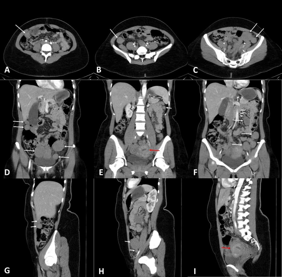 43-year-old female with peritoneal soft tissue lesions. These lesions were biopsy-proven to be leiomyomatous in origin.