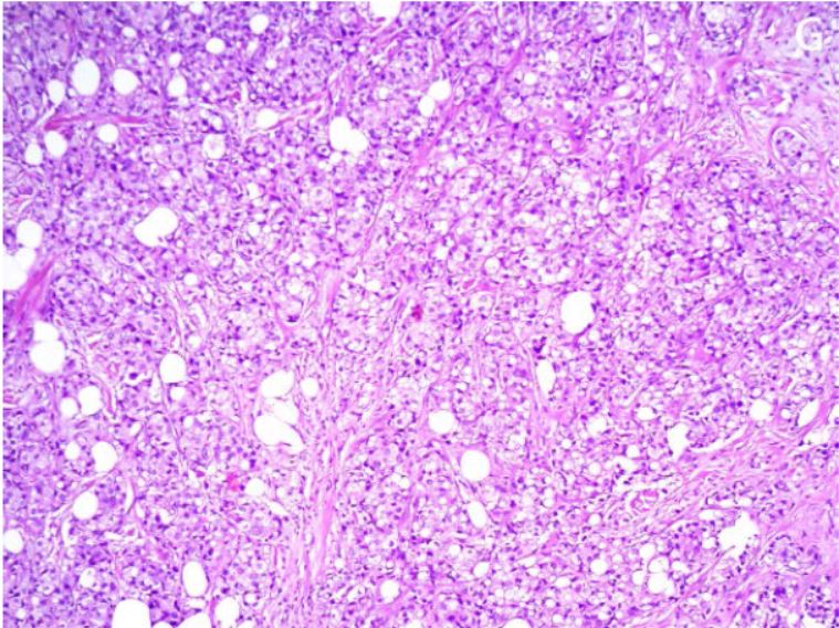 A 59-year-old female with lipid-rich carcinoma.