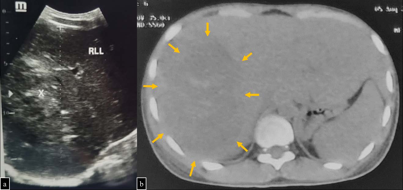 18-year-old male with huge amebic liver abscess