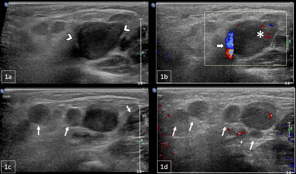 11-month-old male with a palpable, reducible mass in the right inguinal region later diagnosed as Rosai-Dorfman Disease