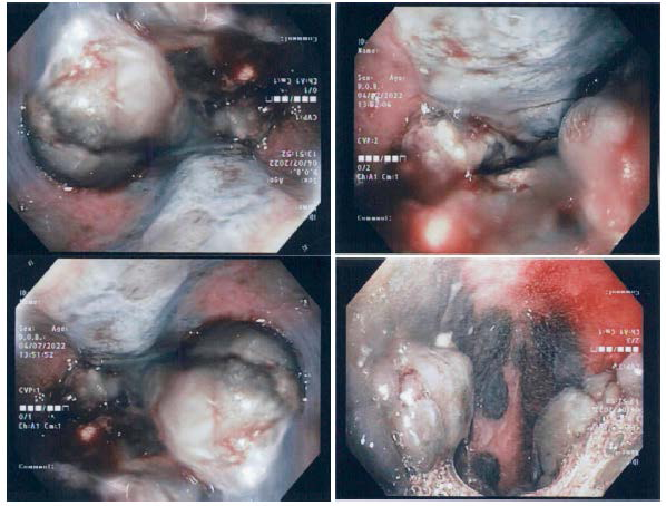 Oesophagogastroduodenoscopy (OGD) findings.