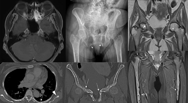 Tumour induced osteopenia due to phosphaturic mesenchymal sinonasal tumour presenting with delayed onset insufficiency fractures