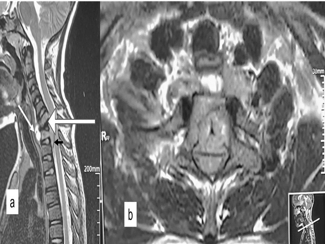 16-year-old male with Alagille syndrome.