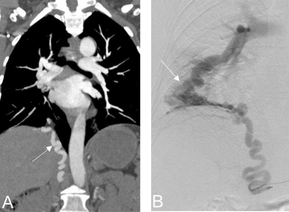 52 -year-old female with a fistula from the right inferior phrenic artery to the right pulmonary artery