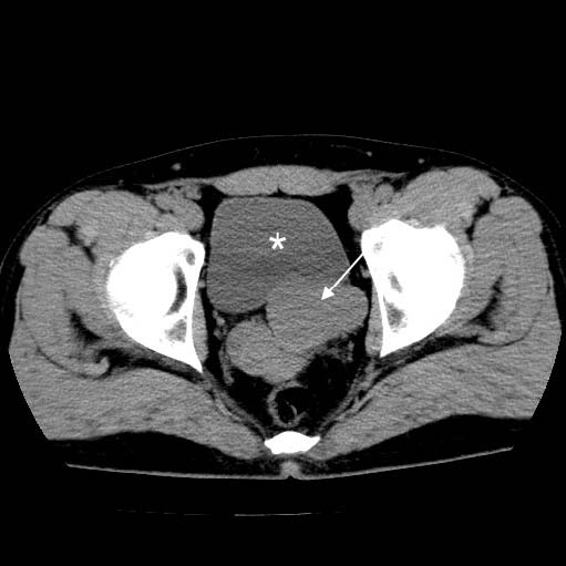 48-year-old male with pelvic pain and dysuria.