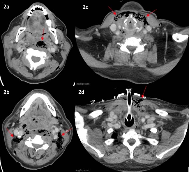 68-year-old male with descending necrotizing mediastinitis.