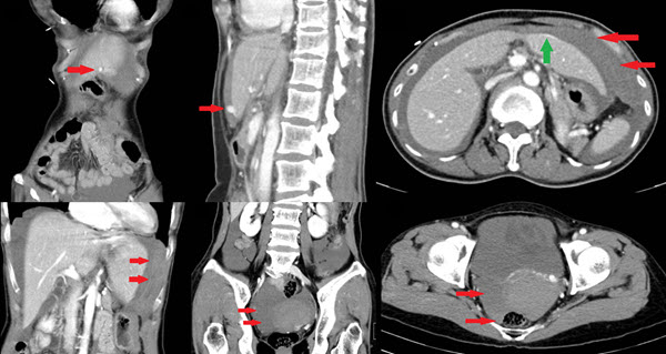 Traditional Chinese Acupuncture Causing Acute Hemoperitoneum from Direct Liver Injury